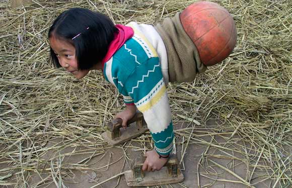 Qian’s family, living in Zhuangxia, China, was unable to afford modern prosthetics and instead used a half a basketball to get around on. Once on the ball she uses two wooden props to help her move around. (photo from http://www.weirdasianews.com/)