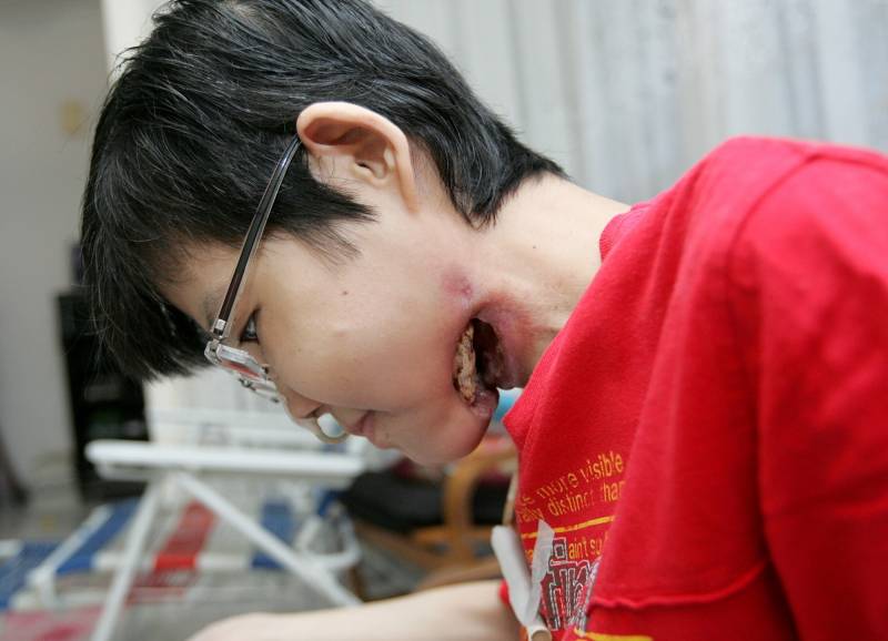 长期服用药物、接受电疗与化疗，导致曾佩仪的下顎骨腐化、血管和细胞坏死，导致下顎陷成一个洞，无法进食。（图：星洲日报）